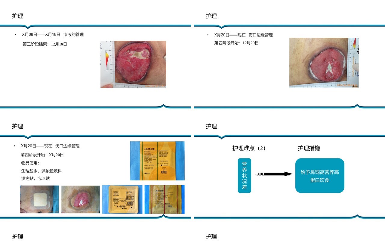胶质瘤术后病人压疮护理PPT模板