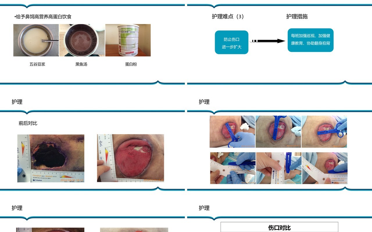 胶质瘤术后病人压疮护理PPT模板