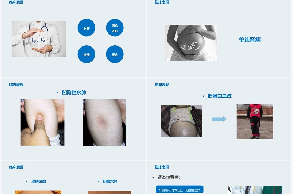 医疗原发性肾病综合征护理查房PPT模板