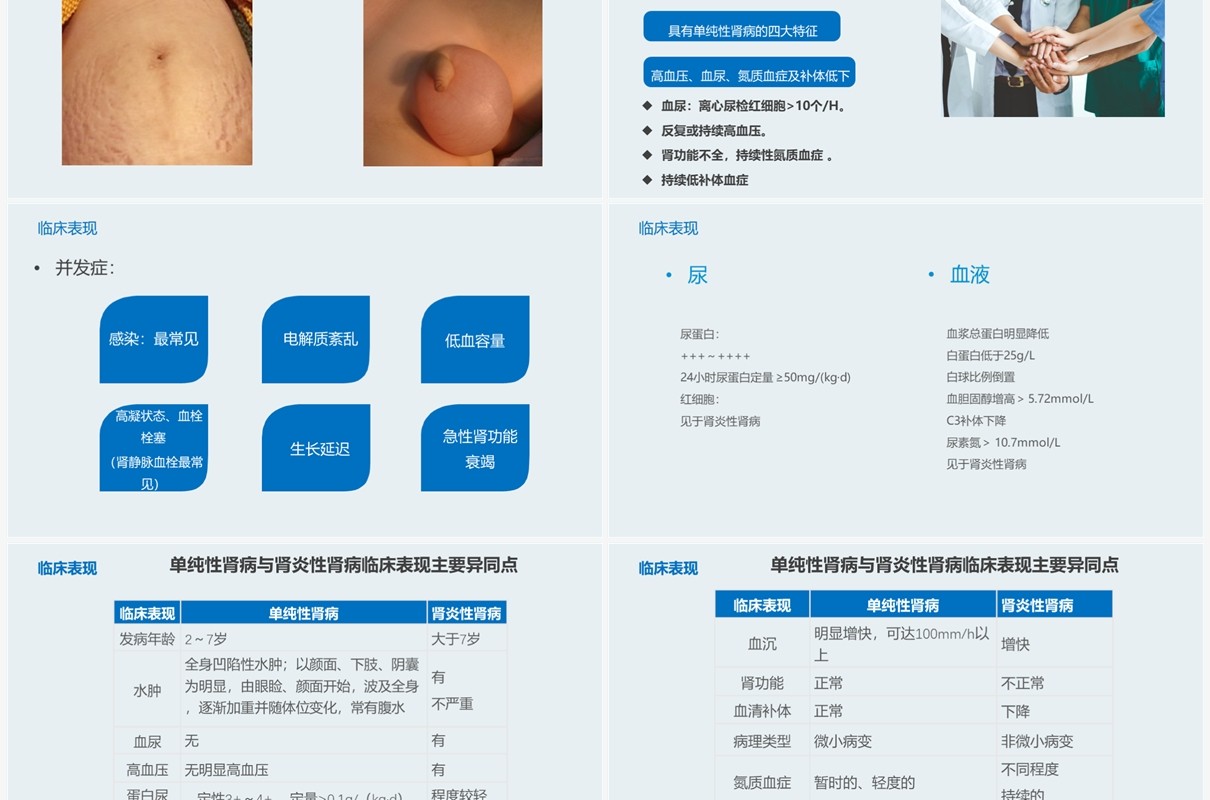 医疗原发性肾病综合征护理查房PPT模板