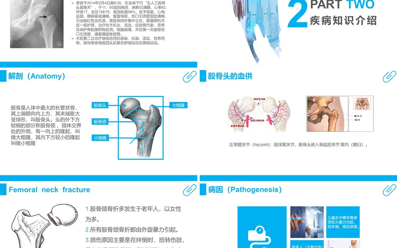 蓝色课件股骨颈骨折护理查房PPT模板