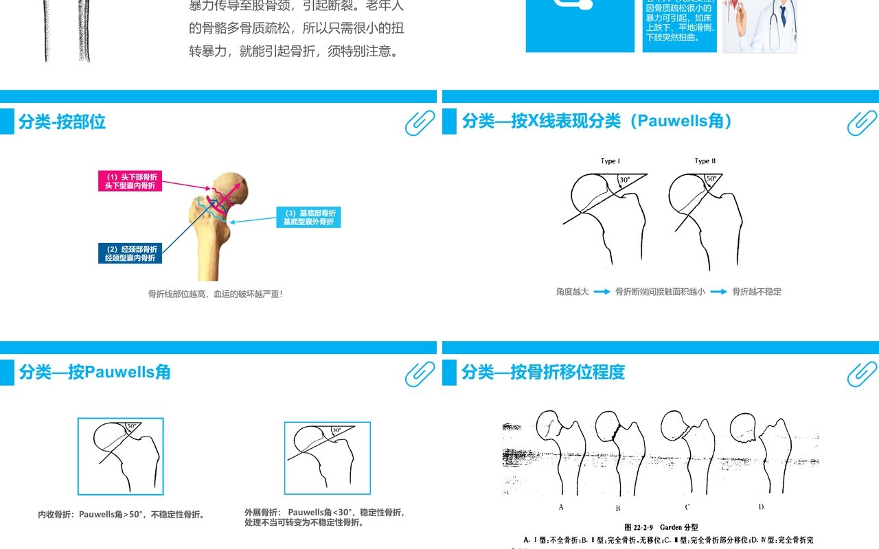蓝色课件股骨颈骨折护理查房PPT模板