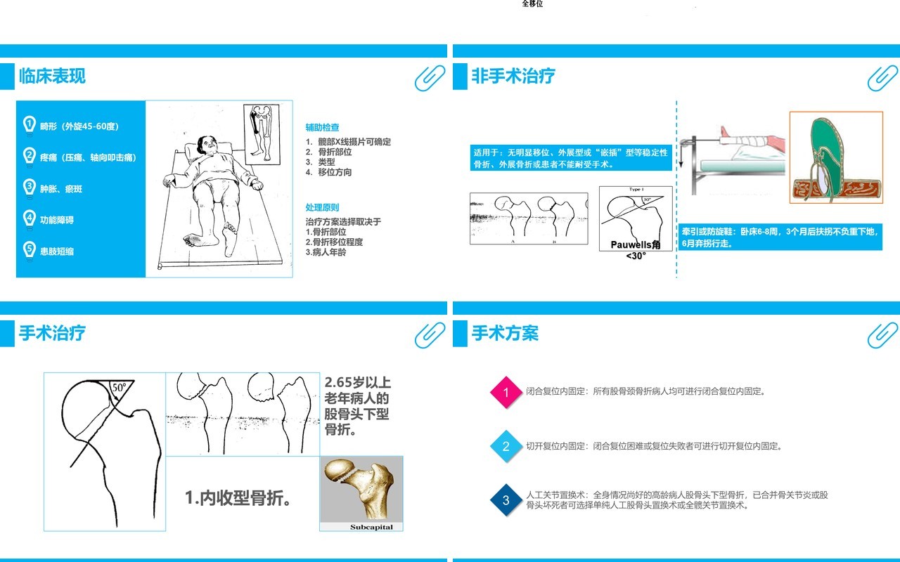 蓝色课件股骨颈骨折护理查房PPT模板