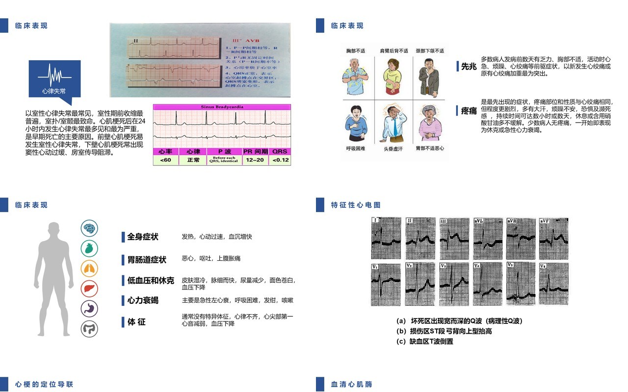 简约急性心肌梗死护理查房PPT模板