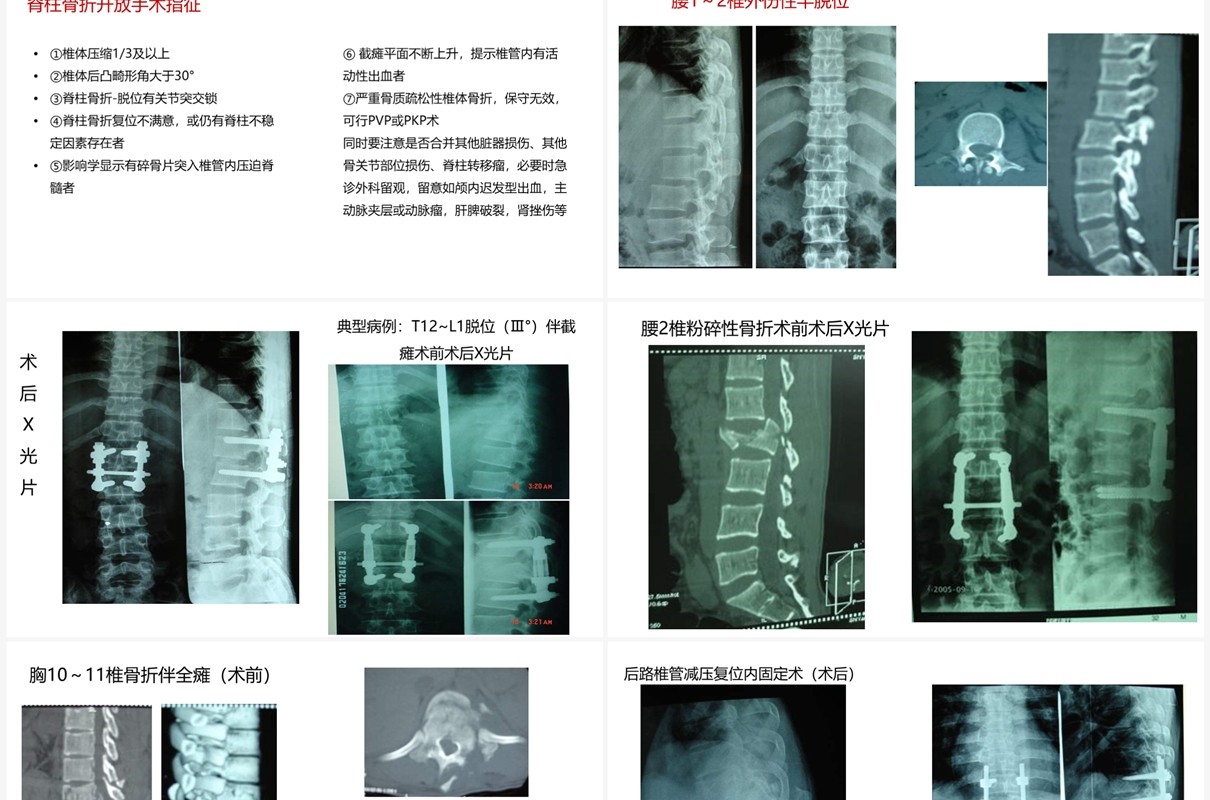 蓝色卡通风脊柱骨折与脊髓损伤PPT模板