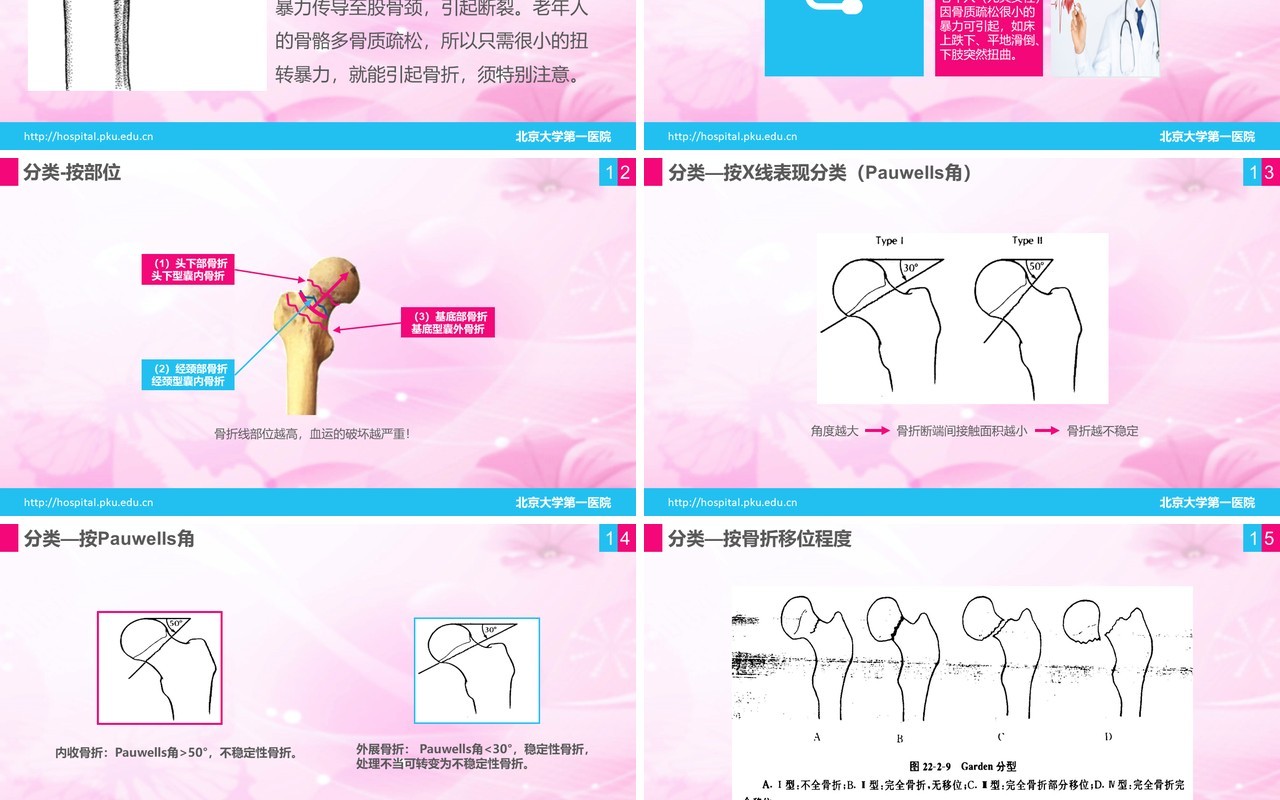 简洁医院医疗股骨颈骨折护理查房PPT模板
