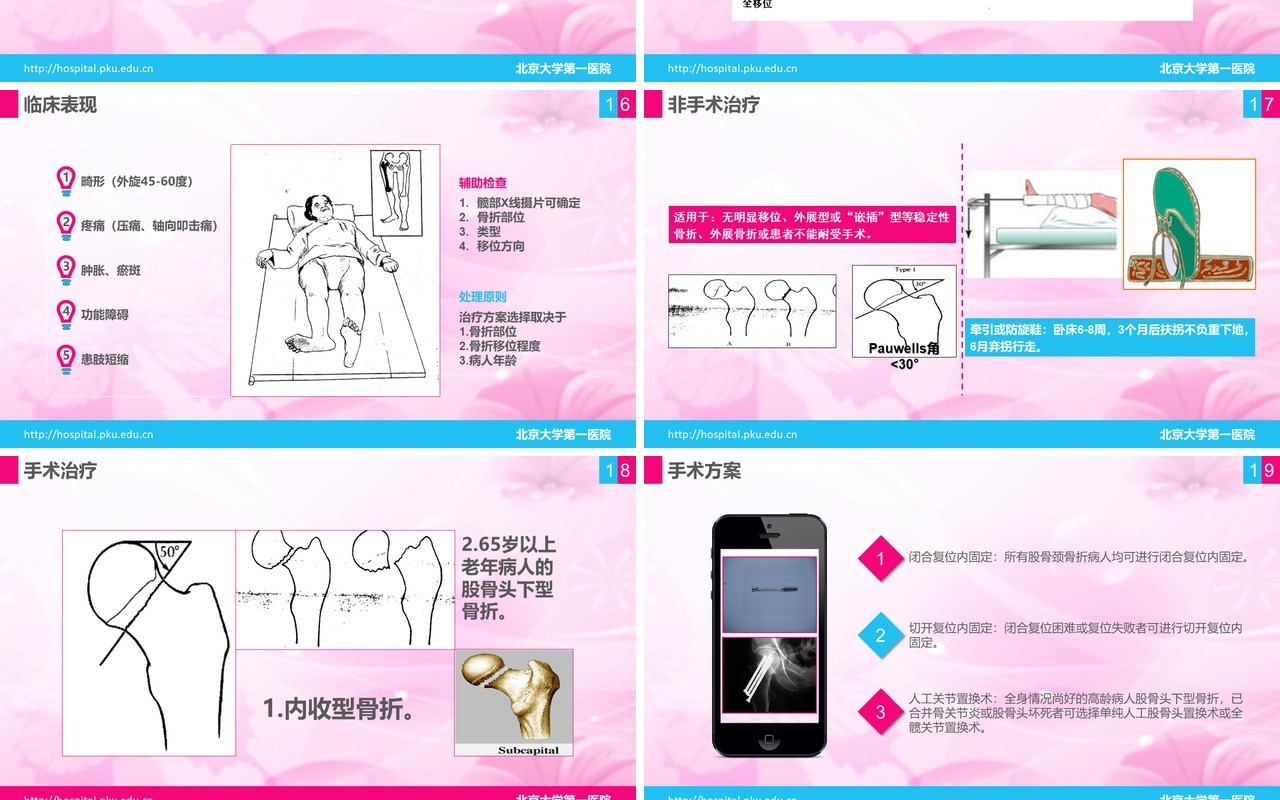 简洁医院医疗股骨颈骨折护理查房PPT模板