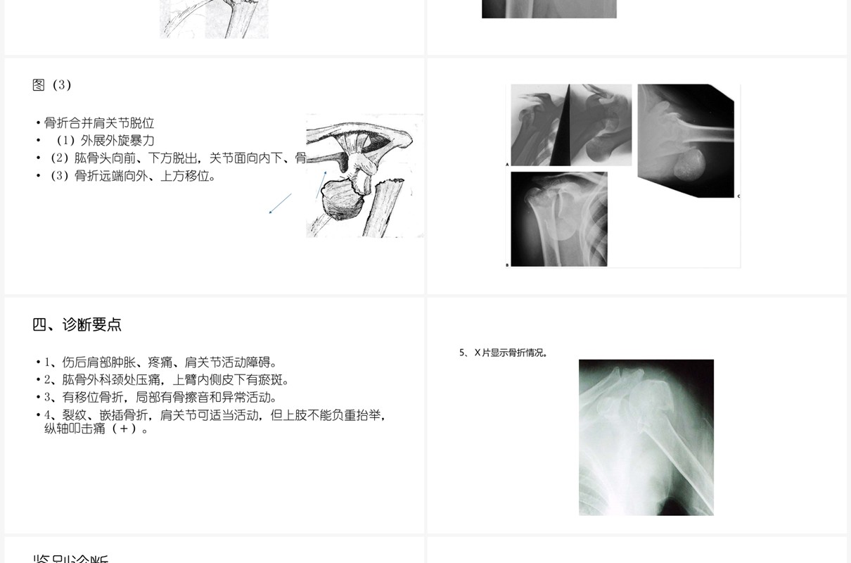 蓝色肱骨外科颈骨折PPT模板